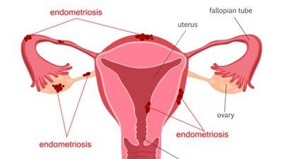 New Study Takes First Step Toward Treating Endometriosis