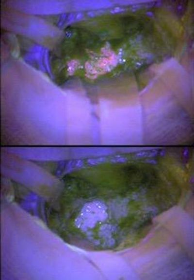 Fluorescent Marker Can Help Guide Surgeons to Remove Dangerous Brain Tumor Cells