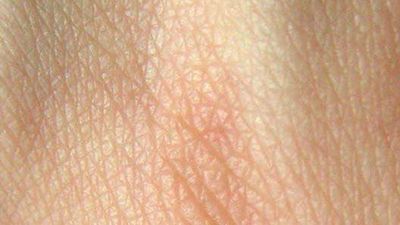 Researchers Use Burn Victims&#39; Own Cells to Regrow Skin up to 30 Percent Quicker