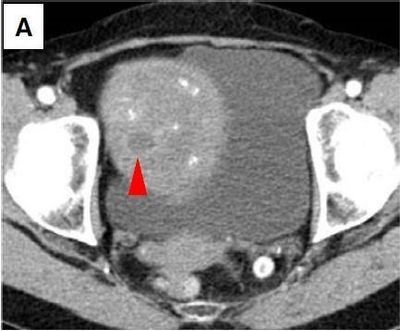 Use of Circulating Tumor DNA to Detect Early Melanoma Growth