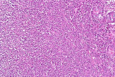 Car-T Therapy Improves Outcomes for Patients with B-Cell Lymphoma