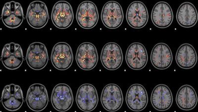 MRI Technique Shows Unique Signatures of Concussion in Rugby Players