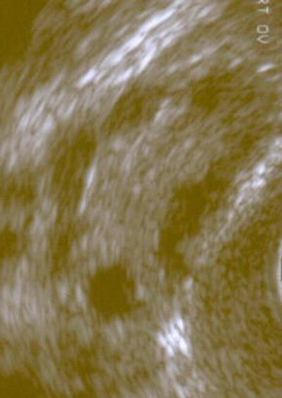 Shared Genetic Architecture for Polycystic Ovary Syndrome Diagnosis