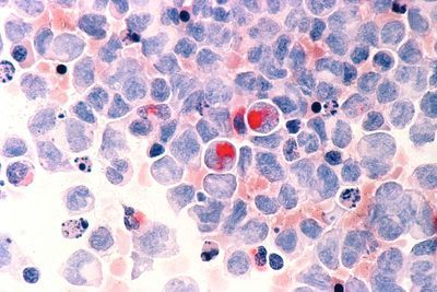 More Accurate Leukemia Diagnosis Expected with Refined Classification