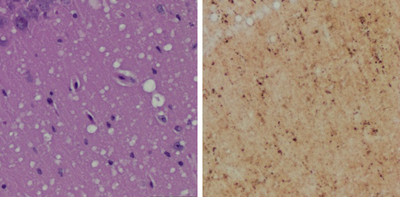 New Skin Test Detects Prion Infection Before Symptoms Appear
