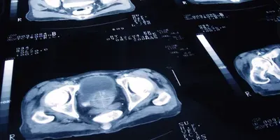 Prostate Cancer
