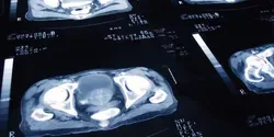 Prostate Cancer