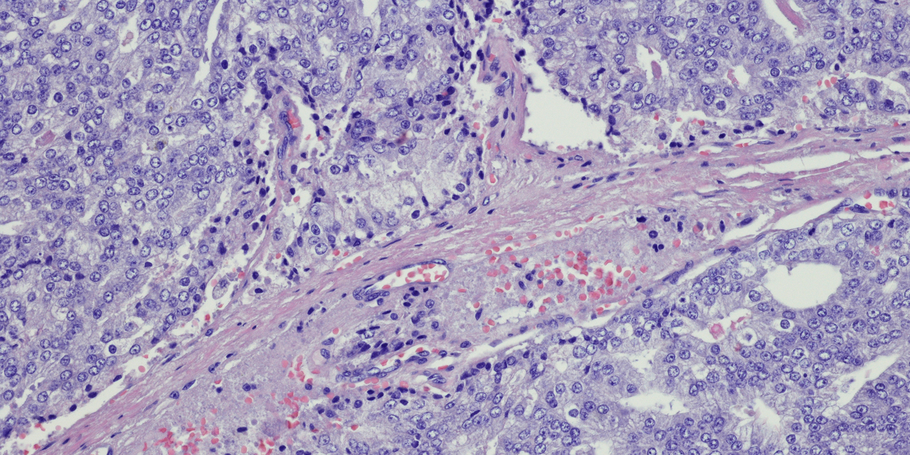 Micrograph of metastatic prostate carcinoma