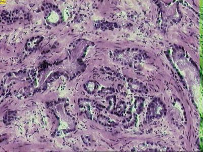 Researchers Develop Prostate Cancer Prediction Tool That Has Unmatched Accuracy