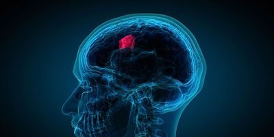 Brain Tumor Graphic