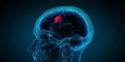 Brain Tumor Graphic