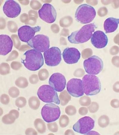 Closer to Identifying Leukemic Stem Cells