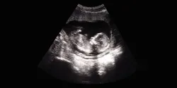 Human Fetus Ultrasound
