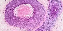 Breast Cancer