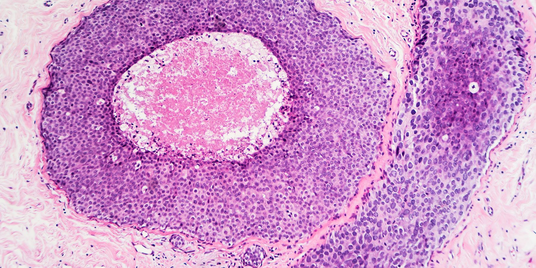 Breast Cancer