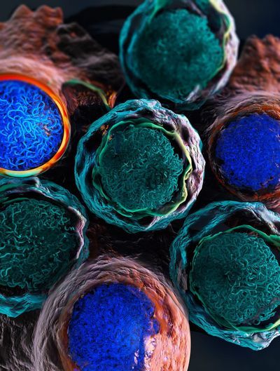 Graphic Leukemia Cells in the Course of Therapy