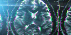 Dementia MRI
