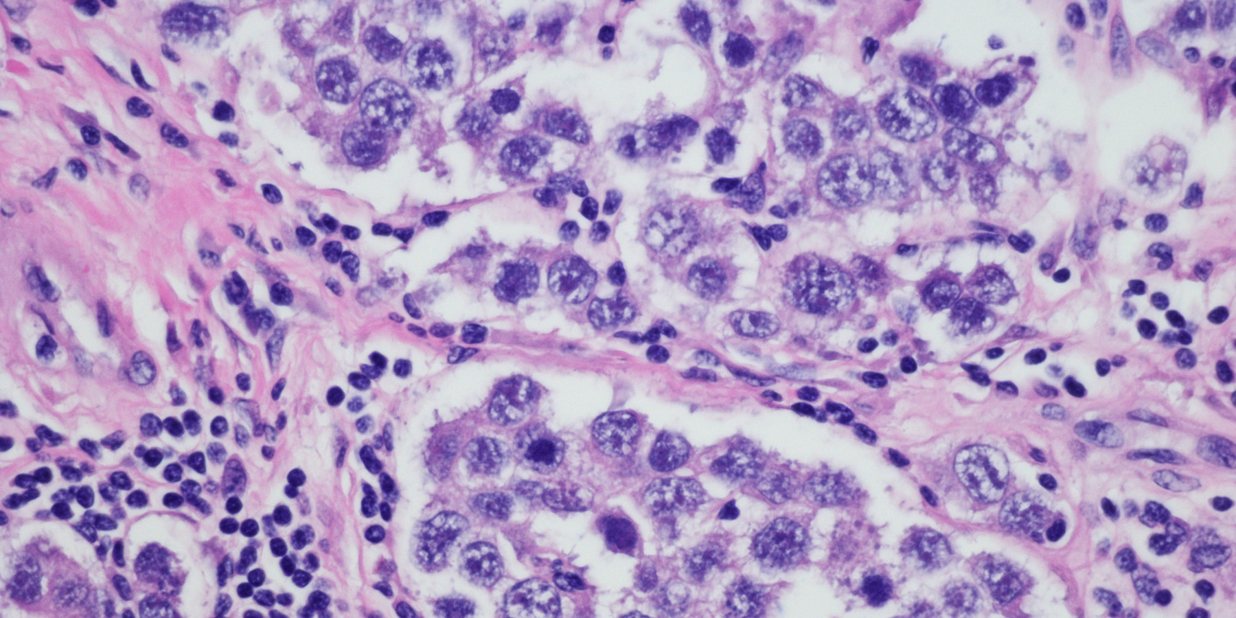 Ovarian Cancer