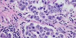 Ovarian Cancer