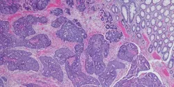 Micrograph of colonic adenocarcinoma with neuroendocrine differe