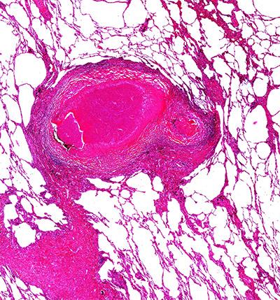 Stained human lung tissue from a patient who was on anti-tuberculous therapy and underwent emergency pneumonectomy 