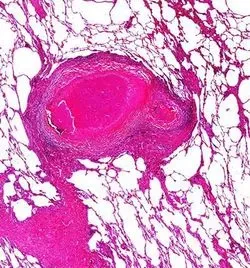 Stained human lung tissue from a patient who was on anti-tuberculous therapy and underwent emergency pneumonectomy 