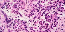 cancer