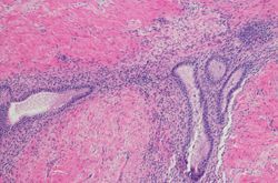 Endometriosis: Theories of Pathogenesis