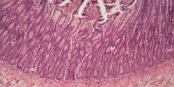 Inflammatory Bowel Disease