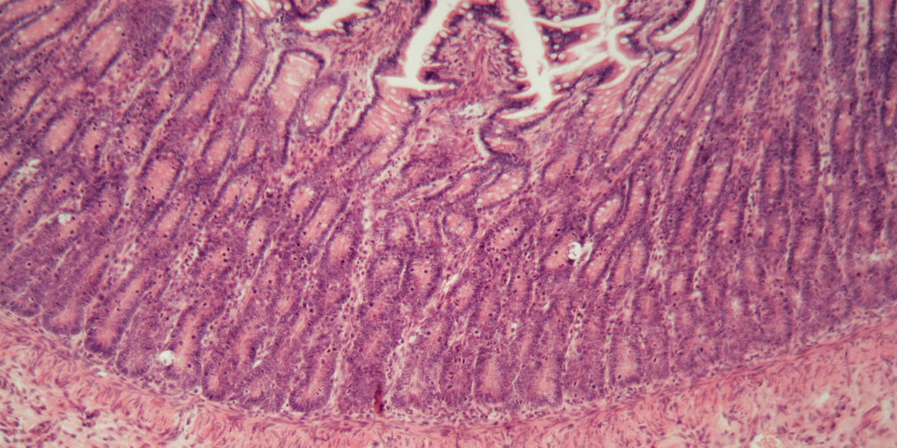 Inflammatory Bowel Disease