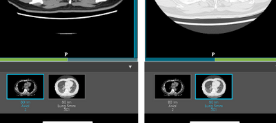 COVID-19 chest CT images in "Join"