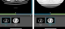 COVID-19 chest CT images in "Join"