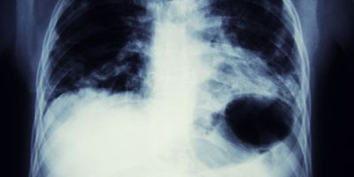 Lung Cancer