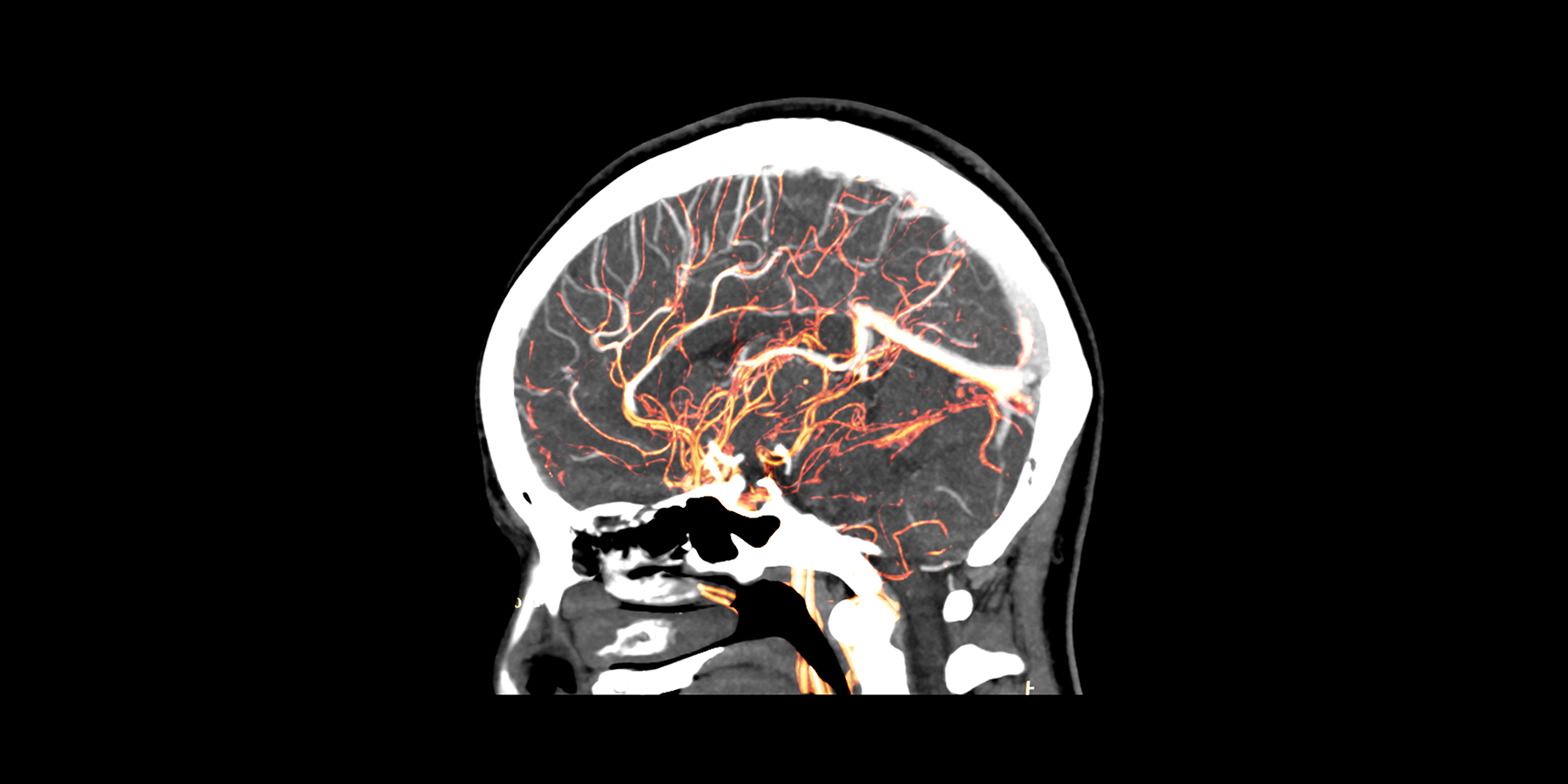 Blood Vessels in Brain