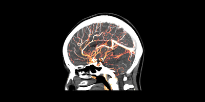 Blood Vessels in Brain