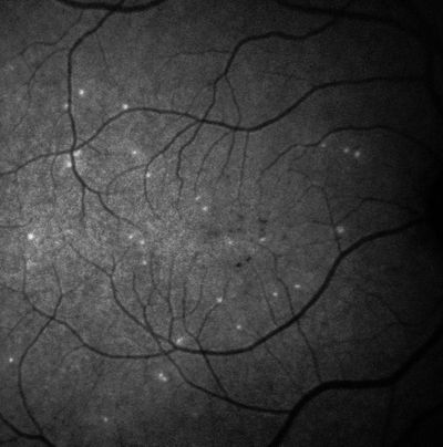 AI-Supported Test for Very Early Signs of Glaucoma Progression