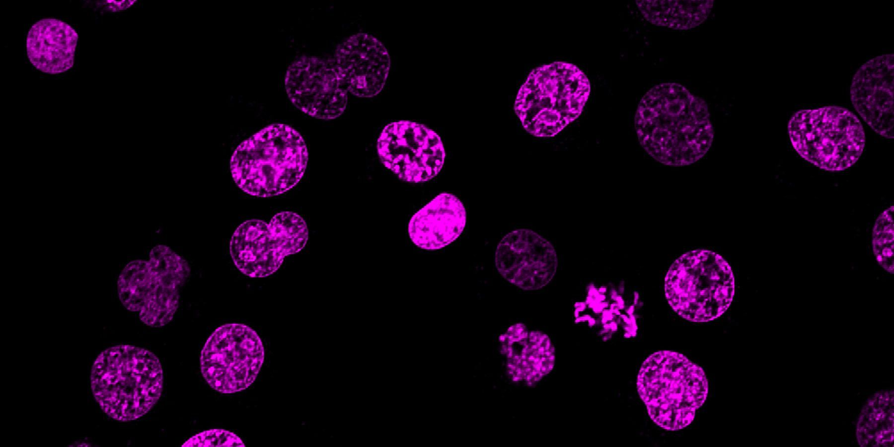 Leukemia Cells Under the Microscope