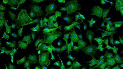 COVID-19 Patients Improve after Heart Cell Therapy