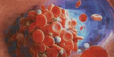 Blood Clot Illustration