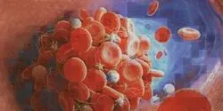 Blood Clot Illustration