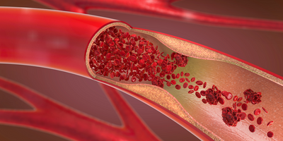 COVID-19 Patients at Risk for Thrombotic Events, Tests Show