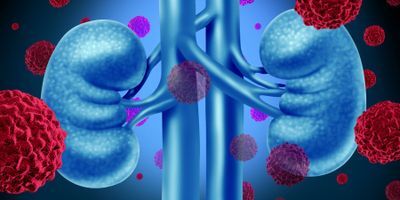 Kidney Cancer Illustration