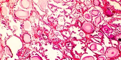 prostate cancer