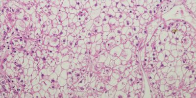 Liver Cancer