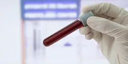 sample for blood test