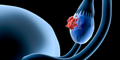 ovarian cancer 3d model