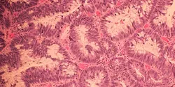 colon cancer