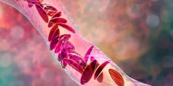 sickle cell anemia illustration