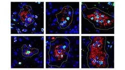 Photomicrographs of human lung tissue taken from a patient who died of COVID-19