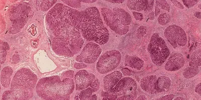 cirrhosis